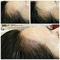 紋髮專家紋髮際線NPM頭皮模擬毛囊技術（HFS）