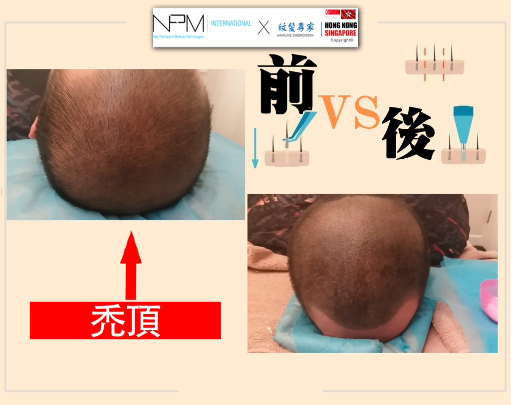 紋髮個案類型︰男生紋髮際線— 禿頭