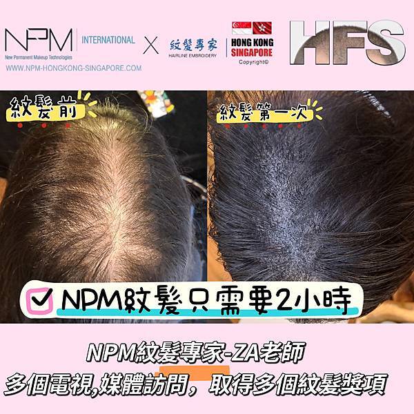 【NPM紋髮專家】-- 讓你擁有自信髮際線