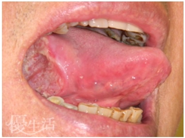 口腔癌 Oral Cancer 蔡佩晏醫師的矯正故事 打造你的微笑曲線專家 Dr Tsai S Blog 痞客邦 口腔癌 Oral Cancer 蔡佩晏醫師的矯正故事 打造你的微笑曲線專家 Dr Tsai S Blog 痞客邦