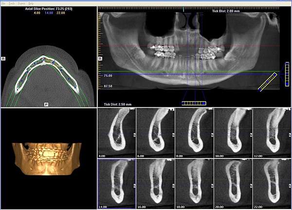 下顎骨骨折 Mandibular Fracture 蔡佩晏醫師的矯正故事 打造你的微笑曲線專家 Dr Tsai S Blog 痞客邦 下顎骨骨折 Mandibular Fracture 蔡佩晏醫師的矯正故事 打造你的微笑曲線專家 Dr Tsai S Blog 痞客邦