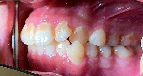 下顎骨骨折 Mandibular Fracture 蔡佩晏醫師的矯正故事 打造你的微笑曲線專家 Dr Tsai S Blog 痞客邦