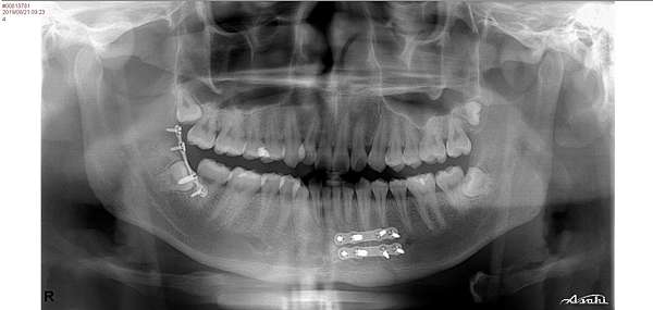 下顎骨骨折 Mandibular Fracture 蔡佩晏醫師的矯正故事 打造你的微笑曲線專家 Dr Tsai S Blog 痞客邦 下顎骨骨折 Mandibular Fracture 蔡佩晏醫師的矯正故事 打造你的微笑曲線專家 Dr Tsai S Blog 痞客邦