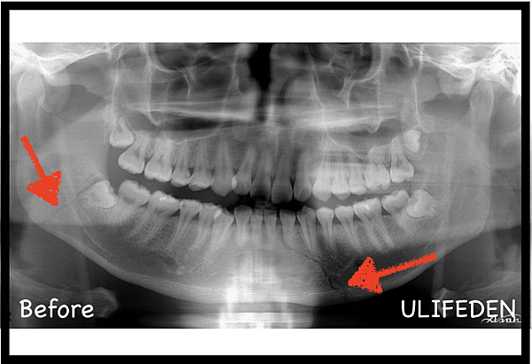 下顎骨骨折 Mandibular Fracture 蔡佩晏醫師的矯正故事 打造你的微笑曲線專家 Dr Tsai S Blog 痞客邦