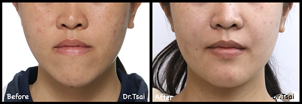 骨性戽斗篇-蔡佩晏醫師的正顎與矯正故事