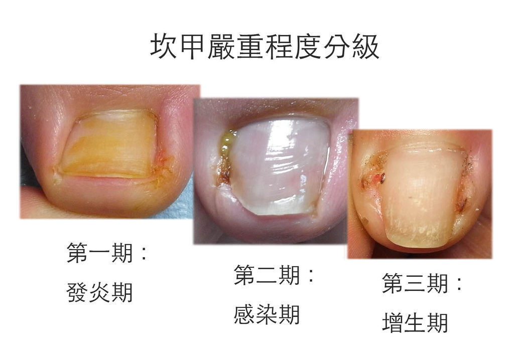 坎甲嚴重程度分級.jpg