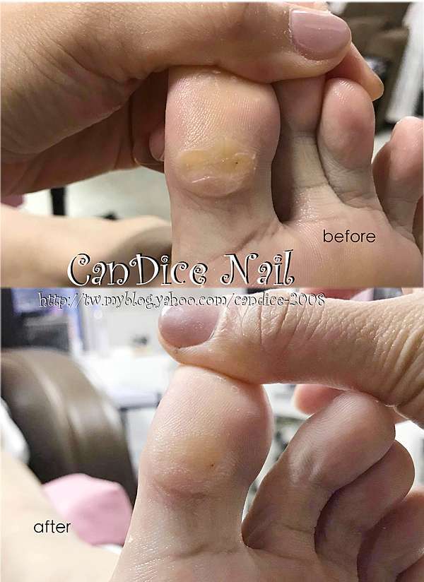 禕宸美甲美睫 關於足部厚皮的問題 Part2 禕宸愛玩美 La Petite Chambre De Candice 痞客邦 禕宸美甲美睫 關於足部厚皮的問題 Part2 禕宸愛玩美 La Petite Chambre De Candice 痞客邦