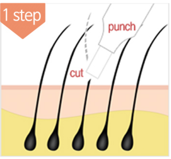 免剃髮植髮 免剃髮植髮