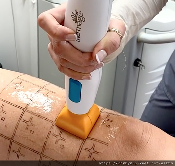 電波拉皮 身體 電波拉皮 身體