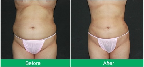 liposuction-abdomen-1.jpg