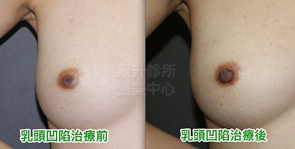 乳頭凹陷1-1.jpg