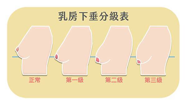 乳房下垂分級 拷貝.jpg