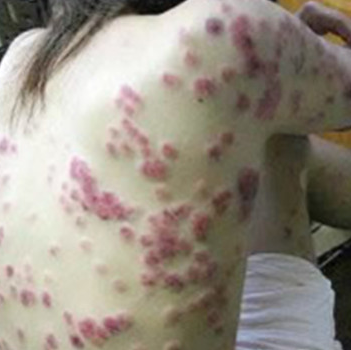 梅毒淋巴腫大起紅疹 懷疑染梅毒應盡速檢驗 民生醫事檢驗所x光檢查 感染愛滋 過敏原檢測 勞工身體體檢 健康檢查諮詢網 梅毒淋巴腫大起紅疹 懷疑染梅毒應盡速檢驗 民生醫事檢驗所x光檢查 感染愛滋 過敏原檢測 勞工身體體檢 健康檢查諮詢網