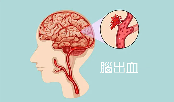 腦出血與三高（高血壓、高膽固醇、高血糖）之間存在密切的關聯