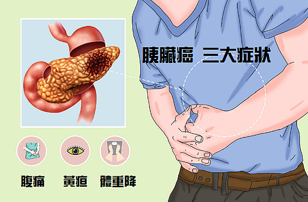 識別胰臟癌早期徵兆的重要性-胰臟癌早期的篩檢指標IRE -1