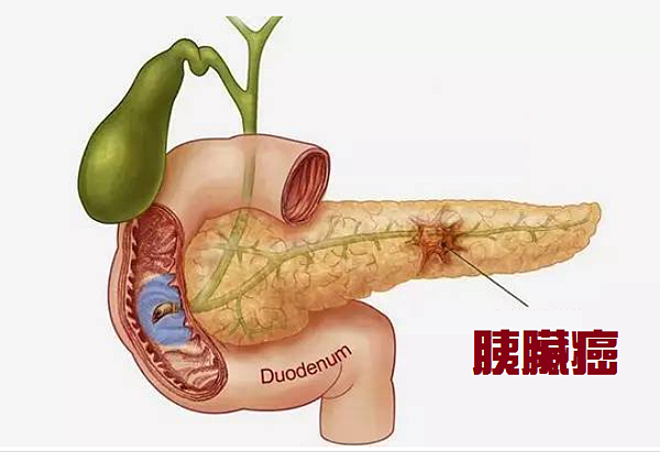 胰臟癌早期的篩檢指標IRE -1檢測高準確性