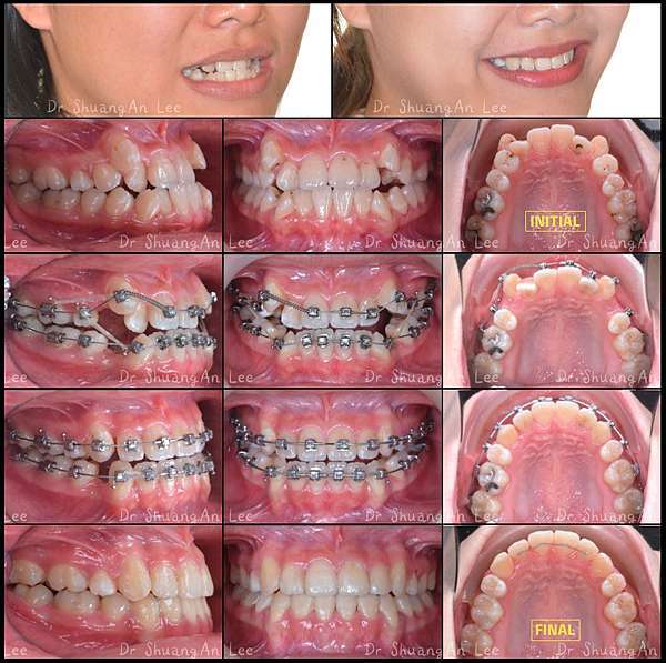 矯正案例集 01 前牙錯咬合併齒列擁擠 李雙安醫師撰寫 李雙安醫師的齒顎矯正部落格 痞客邦