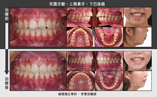 【矯正案例集】《15》笑露牙齦、上顎暴牙、下巴後縮