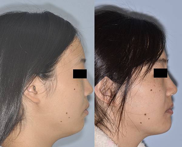 [案例分享] 拔牙合併骨釘改善微凸 笑齦 上顎兩側釘狀側門