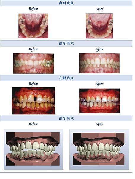 隱形矯正結果