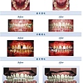 隱形矯正結果