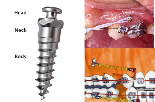 傳統矯正工具特色 骨釘 橡皮筋 Button Tube Bracket Power Chain Hook Sov數位隱形矯正 痞客邦