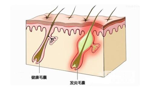 高中體育隊學生做臉青春痘/閉鎖內包粉刺/暗瘡/黑頭粉刺/囊皰