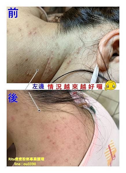 台北專業臉部保養、肩膀脖子長痘痘栗粒腫