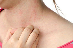 skin-allergy.jpg