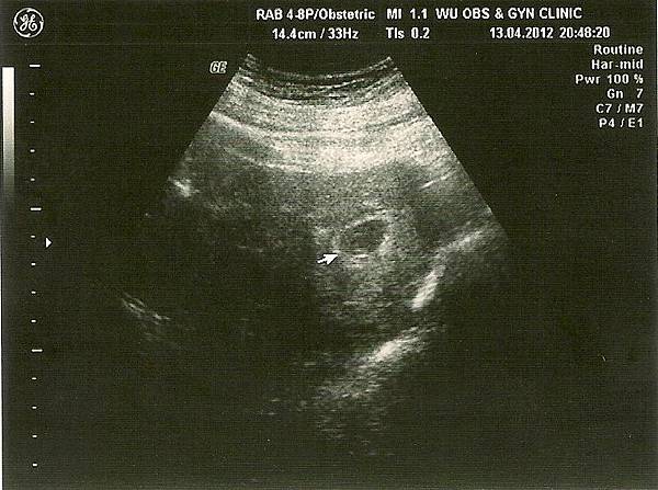 20120413-在吳婦產科確定懷孕
