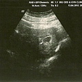 20120413-在吳婦產科確定懷孕