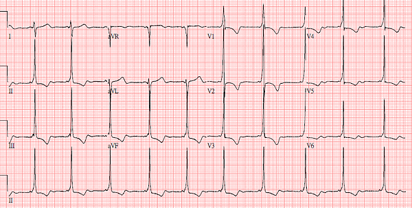 WPW EKG