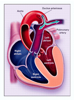patent-ductus-arteriosus