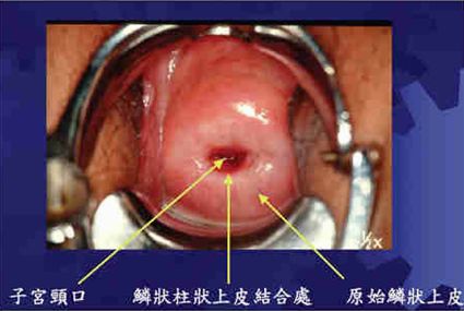 婦科採集子抹技巧