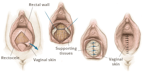 posterior-repair.gif