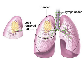 lobectomy.jpg