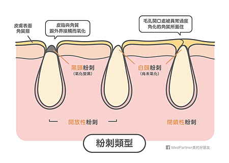 粉刺類型分成：毛孔皮脂阻塞型、黑頭、白頭粉刺