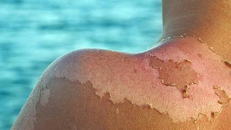 皮膚曬傷脫皮，如果是大面脫皮就屬於重度會嚴重級的曬傷，請立刻就醫。.jpg