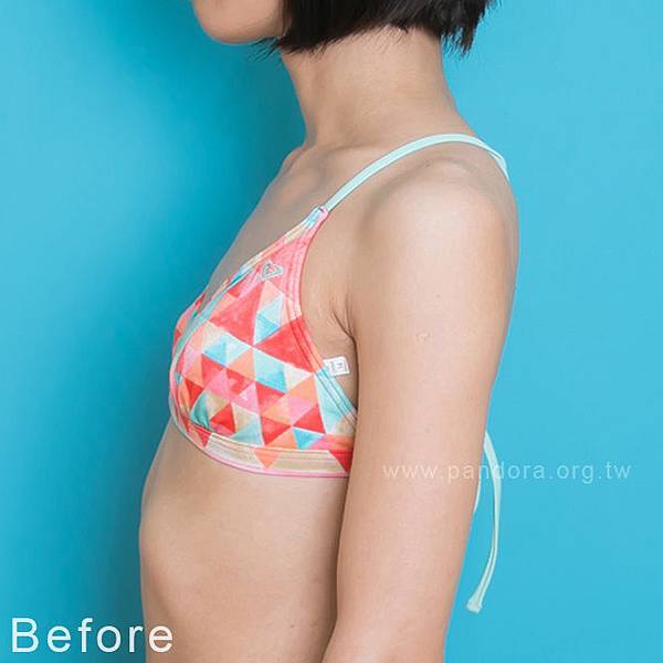 隆乳費用 Motiva魔滴隆乳