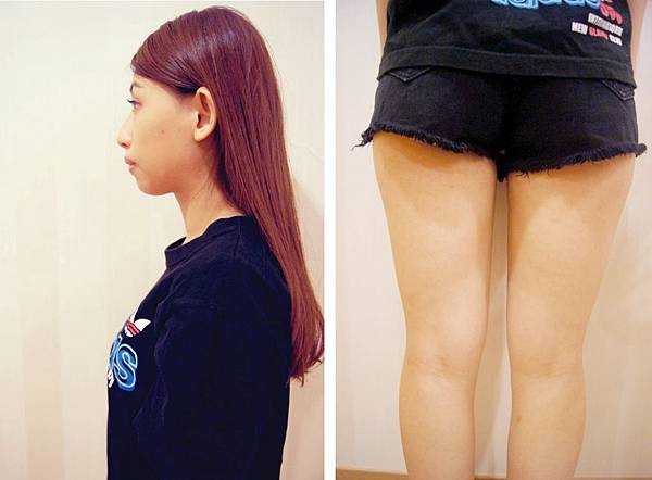 台中自體脂肪 隆乳