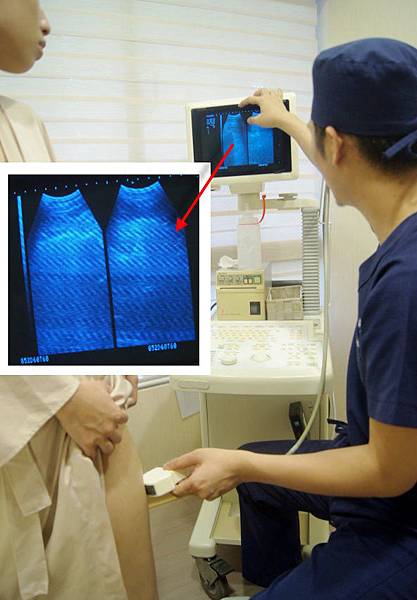 台中自體脂肪 豐胸 台中自體脂肪 豐胸