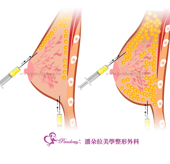 台中自體脂肪 豐胸 台中自體脂肪 豐胸