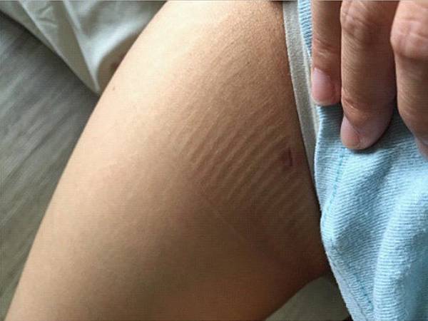 台中自體脂肪 豐胸 台中自體脂肪 豐胸