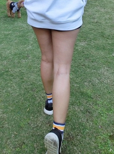 台中肉毒瘦小腿 台中肉毒瘦小腿