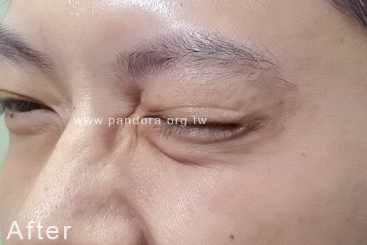 打肉毒魚尾紋 肉毒桿菌 打肉毒推薦 打肉毒魚尾紋 肉毒桿菌 打肉毒推薦