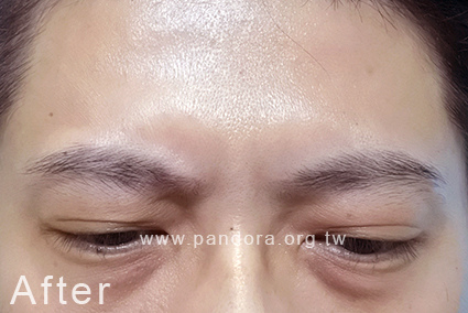 肉毒皺眉 肉毒桿菌 打肉毒推薦 肉毒皺眉 肉毒桿菌 打肉毒推薦