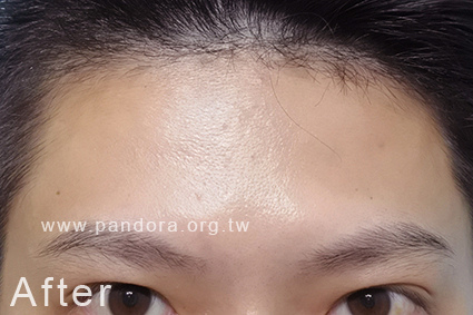 肉毒抬頭紋 肉毒抬頭紋