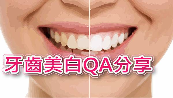 牙齒美白問題QA分享，仙子美學牙齒美白效果超好cp值超高，推薦台北桃園日式除毛