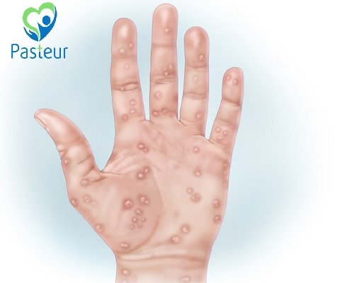 bệnh giang mai ở tay.jpg
