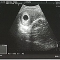 小小的胎囊-2010.4.8